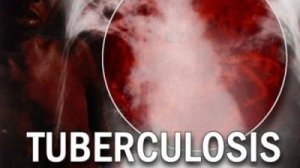 tuberculosis