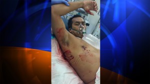 Steve Robles was attacked by a shark on July 6, 2014, sustaining injuries to his right hand and torso area. He is pictured at UCLA Medical Center. (Credit: Robles family)