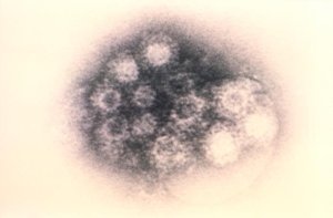 Respiratory illnesses caused by an enterovirus are sending children to hospitals as the disease spreads across the country, health officials say. (Credit: CDC)