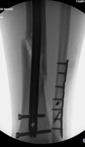 Mark Stangl's broken leg repaired with rod and screws