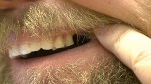 steve-talley-teeth