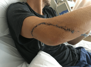 Ryan Boarman's elbow