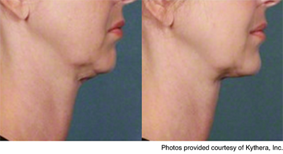 Kybella for double chin before-after (003)