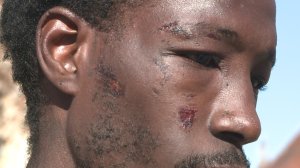 The injuries a Good Samaritan sustained after he tried to be a good role model and break up a fight.
