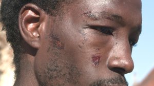 The injuries a Good Samaritan sustained after he tried to be a good role model and break up a fight. 