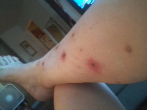 A Huntsville Summit resident shares images of bed bug bites.