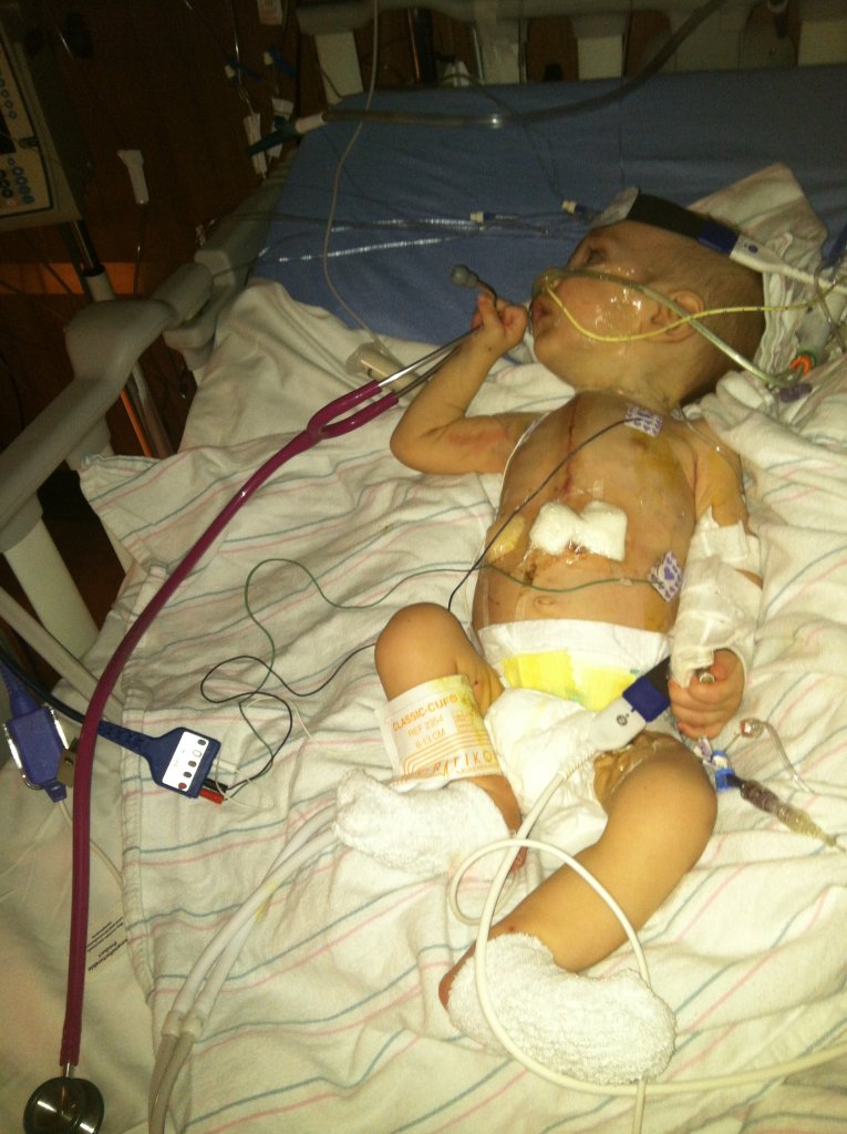 Michael Moretti after heart surgery/Joe Moretti