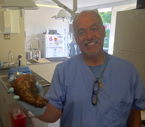 Dr. Baez was able to remove the glue from the stomach