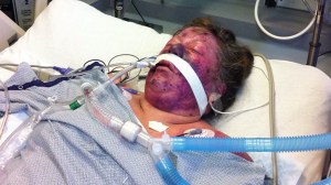 Janet Garner is seen in an ICU after after she developed pneumococcal sepsis. This image was provided by Garner's attorney Moseley Collins. 