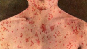 A person with a measles rash is seen in this file photo. 