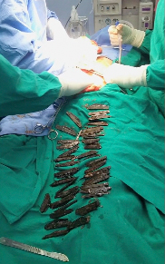A man in India spent two months swallowing knives and had 40 of them surgically removed from his stomach, according to the doctor who led the operation. (Credit: CNN)