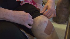 Patricia Gumper, 73, displays the bruises she received during a confrontation with a purse snatcher in Santa Ana on Aug. 10, 2016.. (Credit: KTLA)