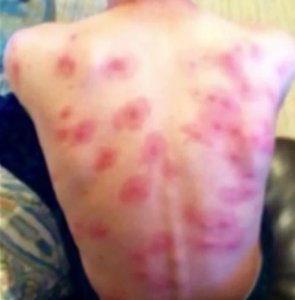 A photo provided by a parent who wanted to remain anonymous on Sept. 27, 2016. shows a rash-like irritation on a student at Lake Forest Elementary School.