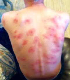 A parent who wished to remain anonymous provided this photo of a rash-like response on a child at Lake Forest Elementary in September 2016.