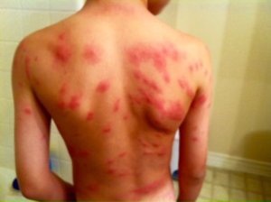 A parent who wished to remain anonymous provided this photo of a rash-like response on a child at Lake Forest Elementary in September 2016.