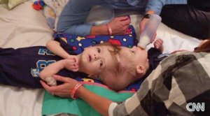 Anias and Jadon McDonald are twins conjoined at the head. Their birth was rare; science says the boys are one in millions. At 13 months old they are undergoing separation surgery. (Credit: CNN)