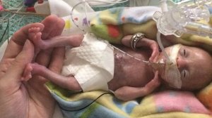 A now 3-year-old girl is seen after she was born at just 21 weeks and four days gestation. (Credit: Courtney Stensrud via CNN)