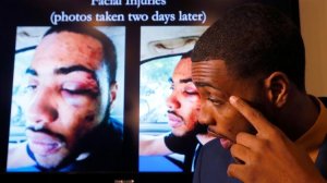 Christopher Ballew, 21, describes injuries he sustained during an arrest by Pasadena police officers, including a broken leg. (Credit: Luis Sinco / Los Angeles Times)