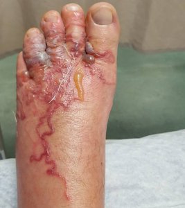 Cutaneous larva migrans occurs when hookworm larvae get into the skin. (Credit: Eddie Zytner / Facebook)