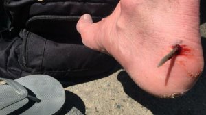 A stingray barb is lodged in the foot of a beachgoer in Huntington Beach in a photo released to the Los Angeles Times by the Huntington Beach Marine Safety Department on Jan. 2, 2018.