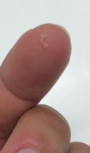 The worm is seen on the patient's finger tip. (Credit: CDC)