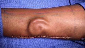 An ear was grown in a soldier’s arm and eventually successfully transplanted. (Credit: U.S. Army)
