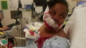 Darlecia D'Andrade is shown in a photo she provided to KTLA after she was injured in a random attack in Carson on June 16, 2018.