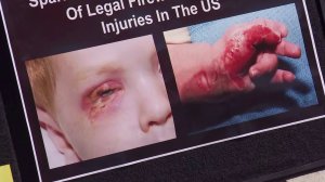 A photo showing a child’s burns and injuries caused by fireworks is seen on July 2, 2018. (Credit: KTLA)