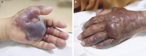 The man's hand and arm were swollen by the time he reached the ER. (Credit: :New England Journal of Medicine)