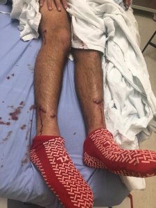 Nick Wapner's bites are shown in a photo provided by his friend, Chris Scopes, on Jan. 8, 2019.
