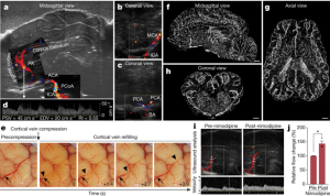 Imaging from a study published on the journal Nature on April 17, 2019 shows restoration of microcirculation and vascular dilatory functionality in brains of pigs. 