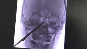 This x-ray, provided by the University of Kansas Health System and obtained by CNN, shows the knife imbedded into Eli Gregg's face.
