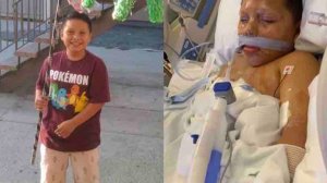 Aaron Carreto, 10, of Compton, pictured before and after a fireworks accident that cost him one of his hands on his 10th birthday on July 6, 2019. (Credit: Carreto family)