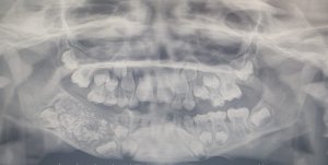 india boy teeth